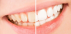 Teeth Whitening coupons and promo codes